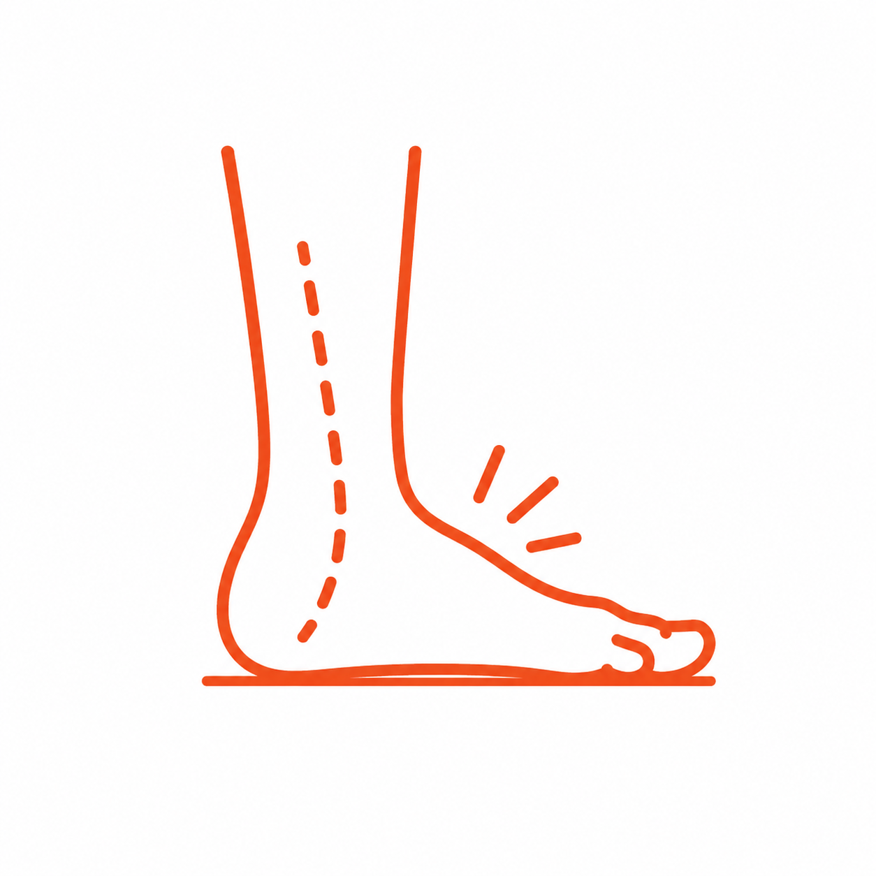 Over Pronation (Flat Feet)